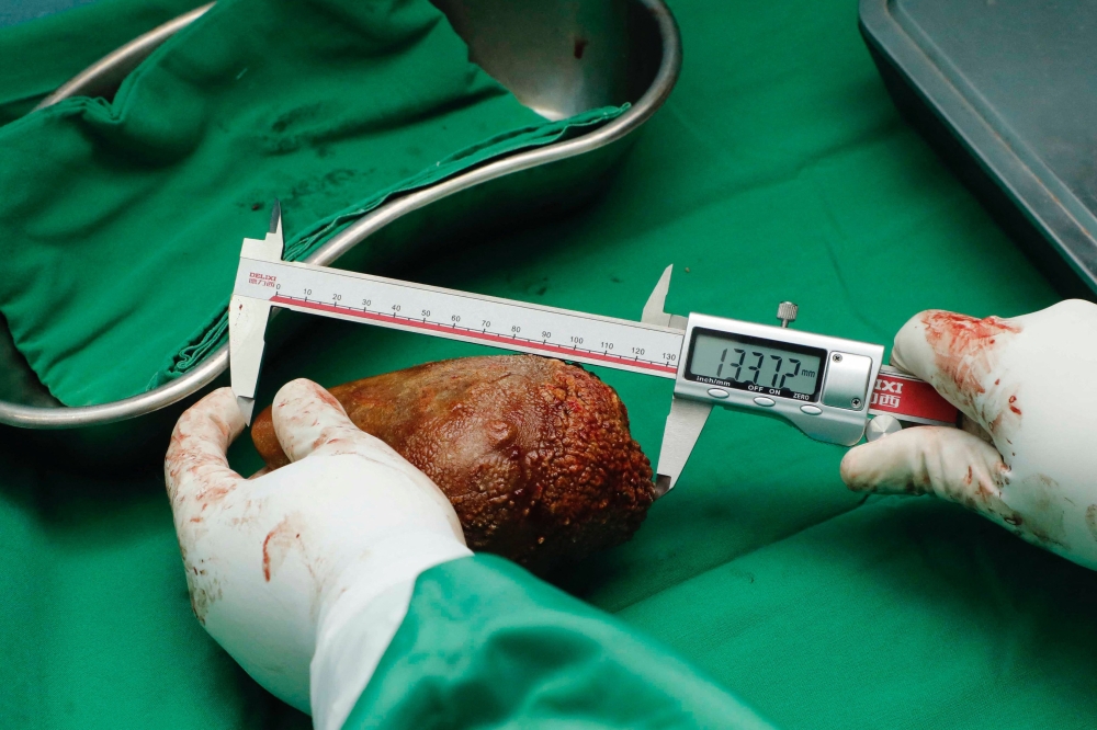 The World’s Largest and Heaviest Kidney Stone Successfully Removed by Sri Lankan Military Doctors